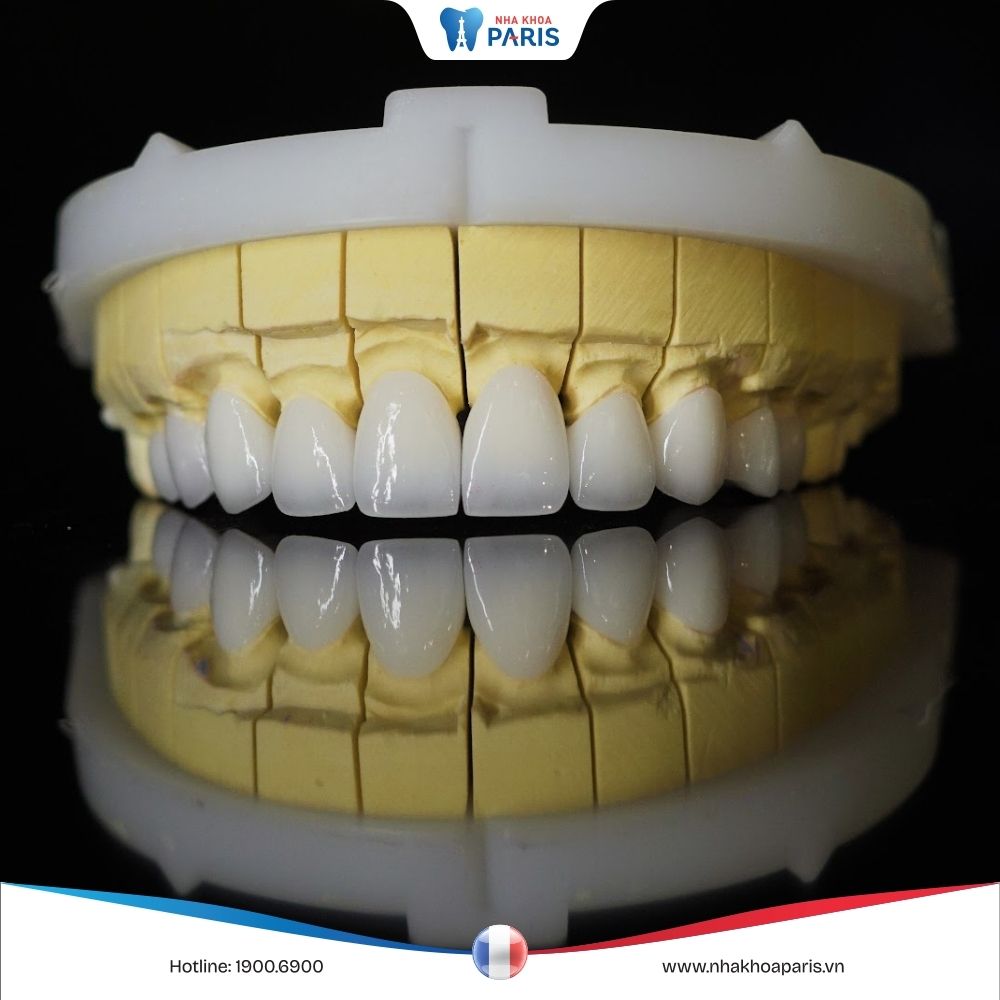 Răng sứ SAGE: Đặc điểm nổi bật, quy trình và chi phí